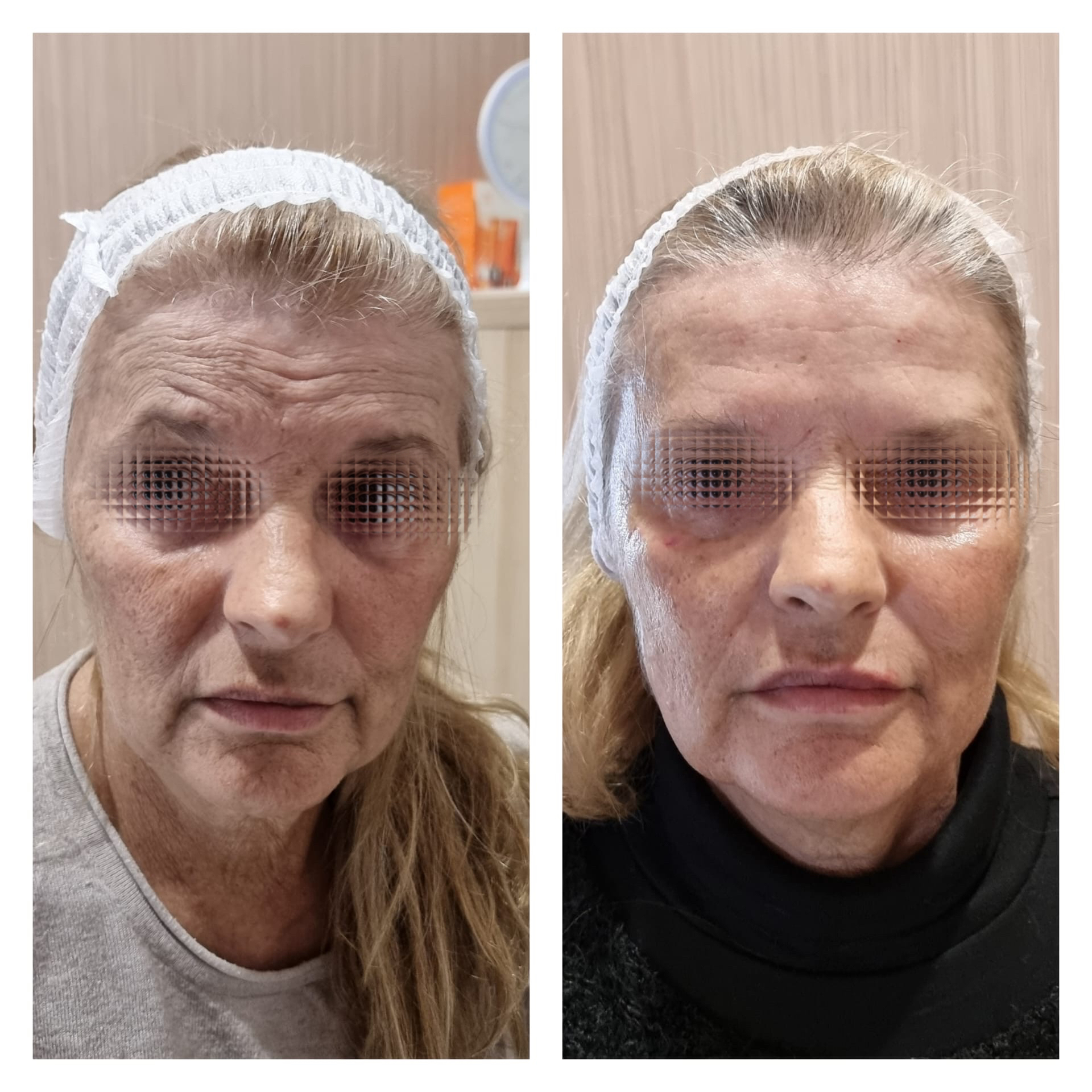 Harmonização Facial